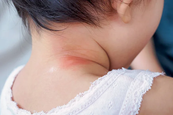 Huiduitslag Bij Baby Allergie Met Rode Vlek Veroorzaakt Door Muggenbeet — Stockfoto