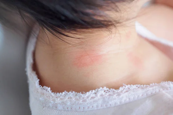 Huiduitslag Bij Baby Allergie Met Rode Vlek Veroorzaakt Door Muggenbeet — Stockfoto