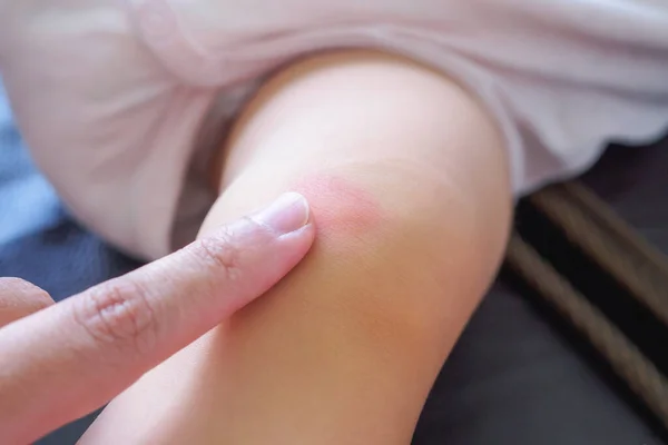 Mother Applying Antiallergic Cream Baby Knee Skin Rash Allergy Red — Stock Photo, Image