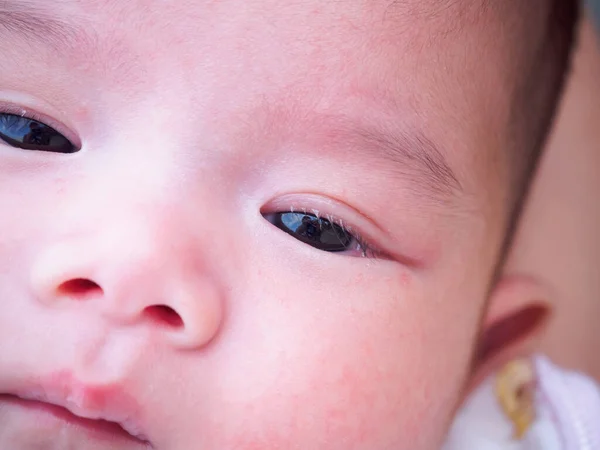 Recém Nascido Com Dermatite Alergia Rosto — Fotografia de Stock