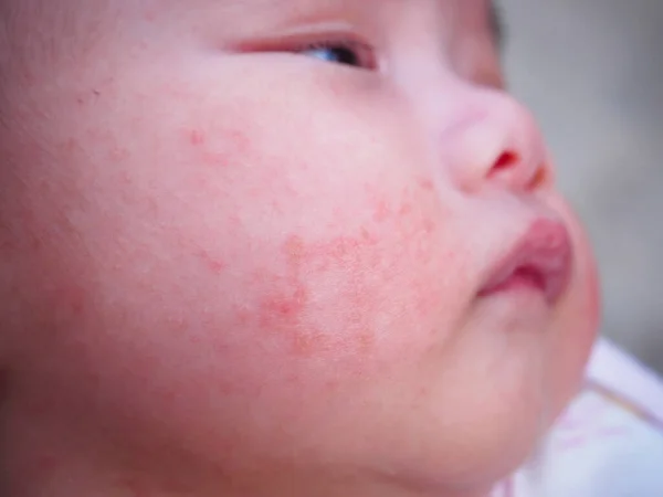 newborn baby with dermatitis allergy on face