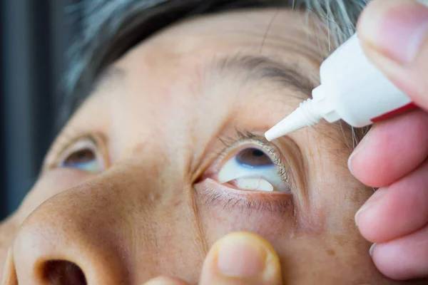 Doctor apply artificial tears gel to senior woman patient eye for treatment dry eye