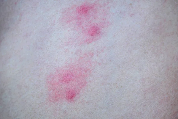 Szúnyogcsípés Okozta Bőrallergia — Stock Fotó