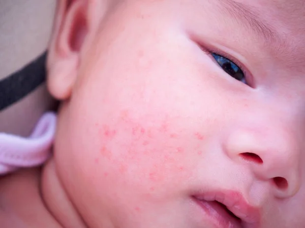 newborn baby with dermatitis allergy on face