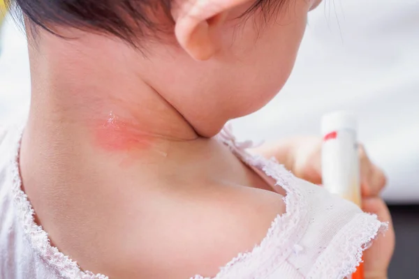 Сыпь Коже Ребенка Аллергия Красным Пятном Вызванная Укусом Комара Шее — стоковое фото