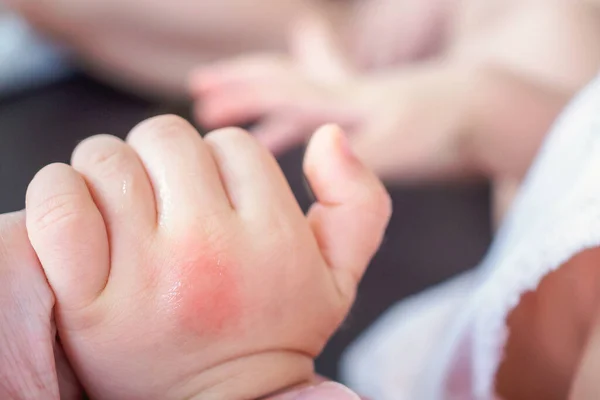 Babyhand Med Hudutslag Och Allergi Med Röd Fläck Orsakad Myggbett — Stockfoto