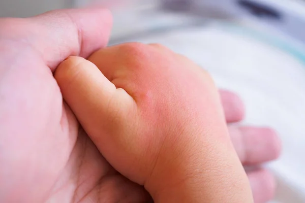 Babyhand Med Hudutslag Och Allergi Med Röd Fläck Orsakad Myggbett — Stockfoto