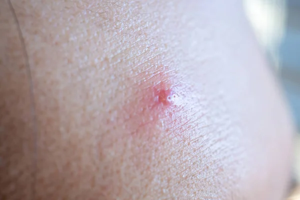 Inflammatory Acne Red Spot Face Closeup — Stock Photo, Image