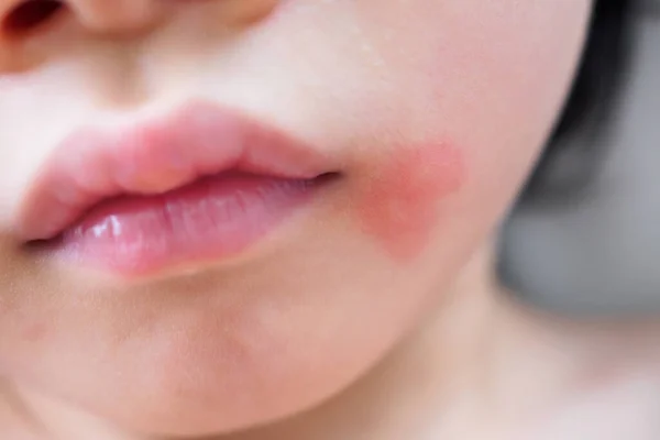 Маленькая Азиатка Кожная Сыпь Аллергия Красным Пятном Вызванная Укусом Комара — стоковое фото
