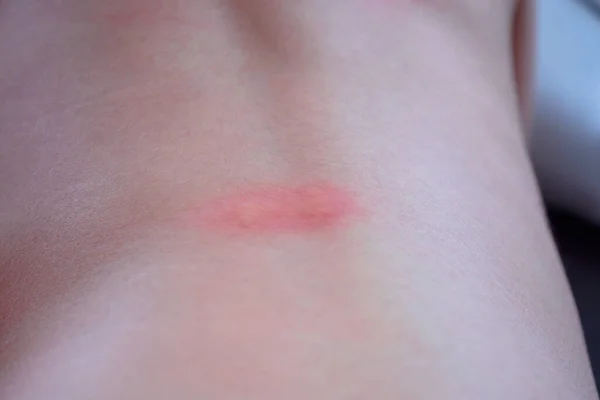 Kis Ázsiai Lány Bőr Kiütés Allergia Vörös Folt Okozta Szúnyogcsípés — Stock Fotó