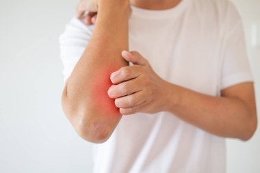 Kaşındıran ve kaşındıran bir adam kaşındıran kuru cilt egzama dermatiti.