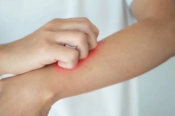 Man Itching Scratching Arm Itchy Dry Skin Eczema Dermatitis — Stock Photo, Image