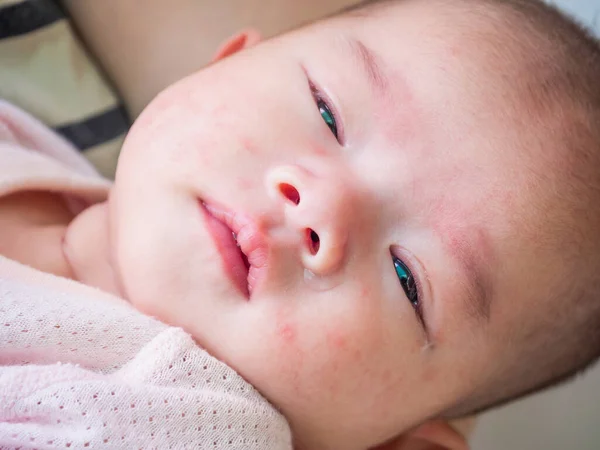 Новорожденный Ребенок Аллергией Дерматит Лице — стоковое фото