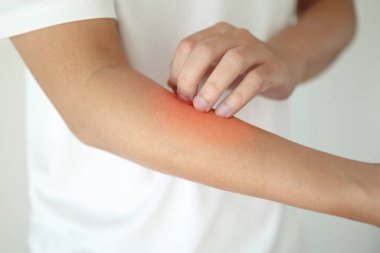 Kaşındıran ve kaşındıran bir adam kaşındıran kuru cilt egzama dermatiti.