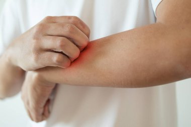 Kaşındıran ve kaşındıran bir adam kaşındıran kuru cilt egzama dermatiti.