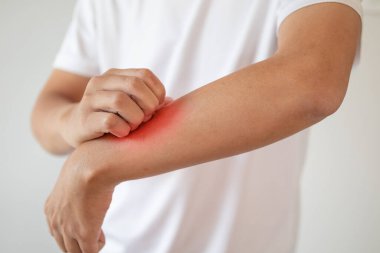 Kaşındıran ve kaşındıran bir adam kaşındıran kuru cilt egzama dermatiti.
