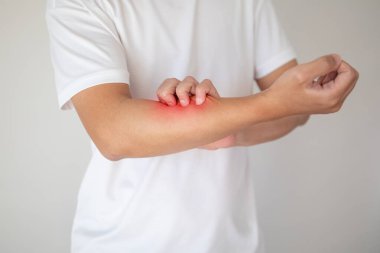 Kaşındıran ve kaşındıran bir adam kaşındıran kuru cilt egzama dermatiti.