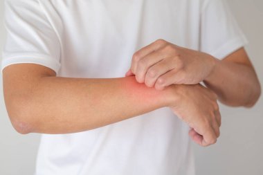 Kaşındıran ve kaşındıran bir adam kaşındıran kuru cilt egzama dermatiti.