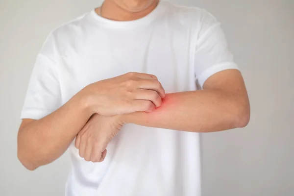 Comichão Homem Arranhões Braço Prurido Pele Seca Eczema Dermatite — Fotografia de Stock