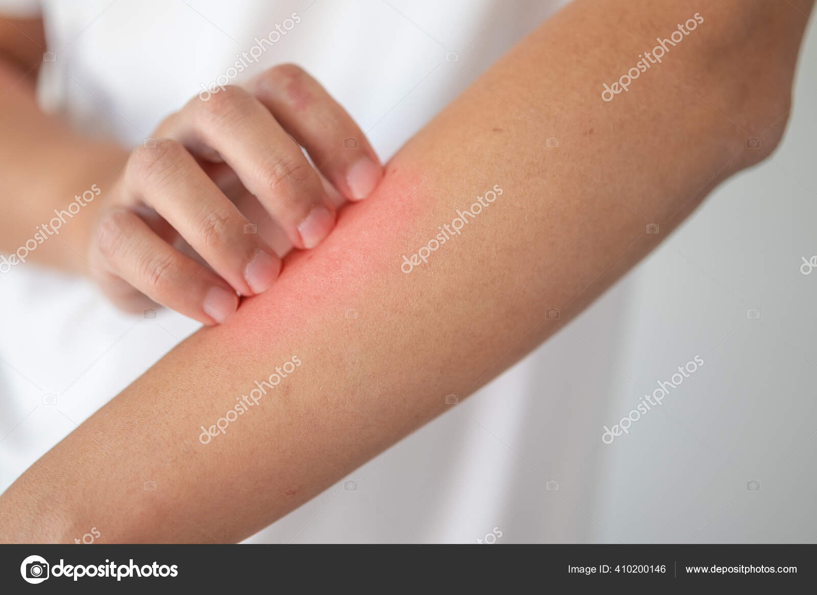 Comichão Homem Arranhões Braço Prurido Pele Seca Eczema Dermatite — Foto ©  Kwangmoozaa #410200146, image size:1600x1167