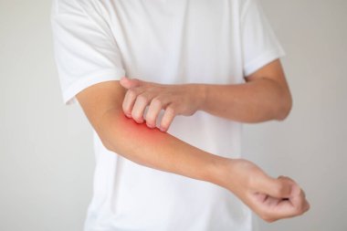 Kaşındıran ve kaşındıran bir adam kaşındıran kuru cilt egzama dermatiti.