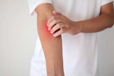 Kaşındıran ve kaşındıran bir adam kaşındıran kuru cilt egzama dermatiti.