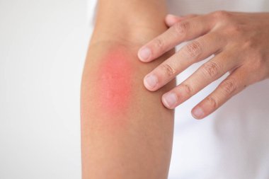 Kaşındıran ve kaşındıran bir adam kaşındıran kuru cilt egzama dermatiti.