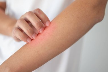 Kaşındıran ve kaşındıran bir adam kaşındıran kuru cilt egzama dermatiti.