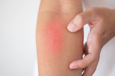 Kaşındıran ve kaşındıran bir adam kaşındıran kuru cilt egzama dermatiti.