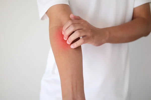 Hombre Picazón Arañazos Brazo Por Picazón Piel Seca Eczema Dermatitis — Foto de Stock