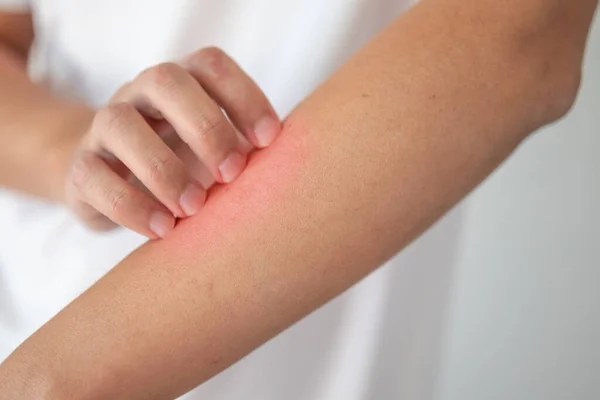 Man Itching Scratching Arm Itchy Dry Skin Eczema Dermatitis — Stock Photo, Image