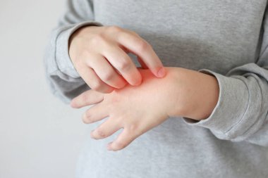 Genç Asyalı kadın kaşındırıyor ve kaşındırıyor. Cilt kuruluğu, egzama dermatiti.