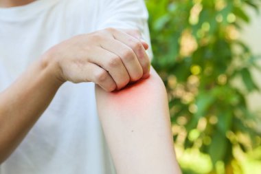 Alerji yüzünden kaşınan ve kollarında kaşıntı olan bir adam var.