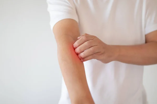 Mann Juckt Und Kratzt Arm Von Juckenden Trockenen Hautekzemen Dermatitis — Stockfoto