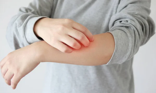 Young Asian Woman Itching Scratching Arm Itchy Dry Skin Eczema — Stock Photo, Image