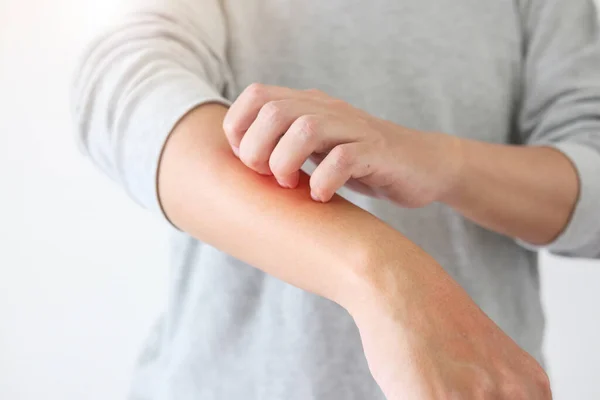 Joven Asiático Hombre Picazón Arañazos Brazo Picazón Piel Seca Eczema —  Fotos de Stock