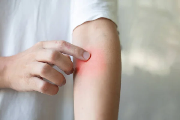 Hombre Picazón Arañazos Brazo Por Picadura Insecto Picazón Piel Seca —  Fotos de Stock