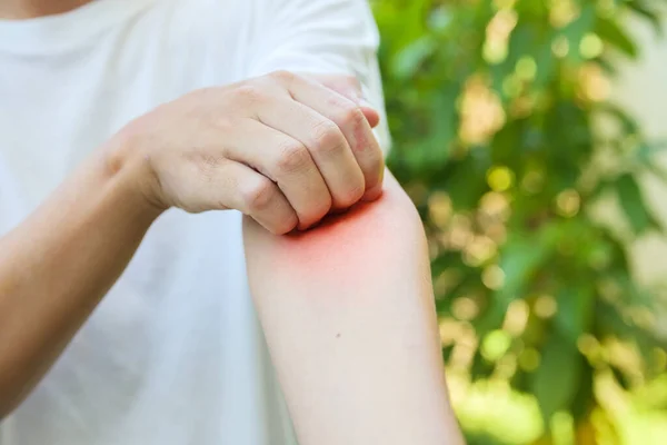 Man Jeuk Krassen Arm Van Allergie Huiduitslag Veroorzaakt Door Insectenbeet — Stockfoto