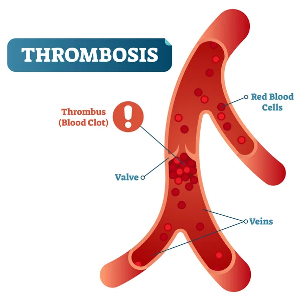 Trombose ilustração vetorial médica diagrama de seção transversal, doença do sistema circulatório dos vasos sanguíneos não saudável. . — Vetor de Stock