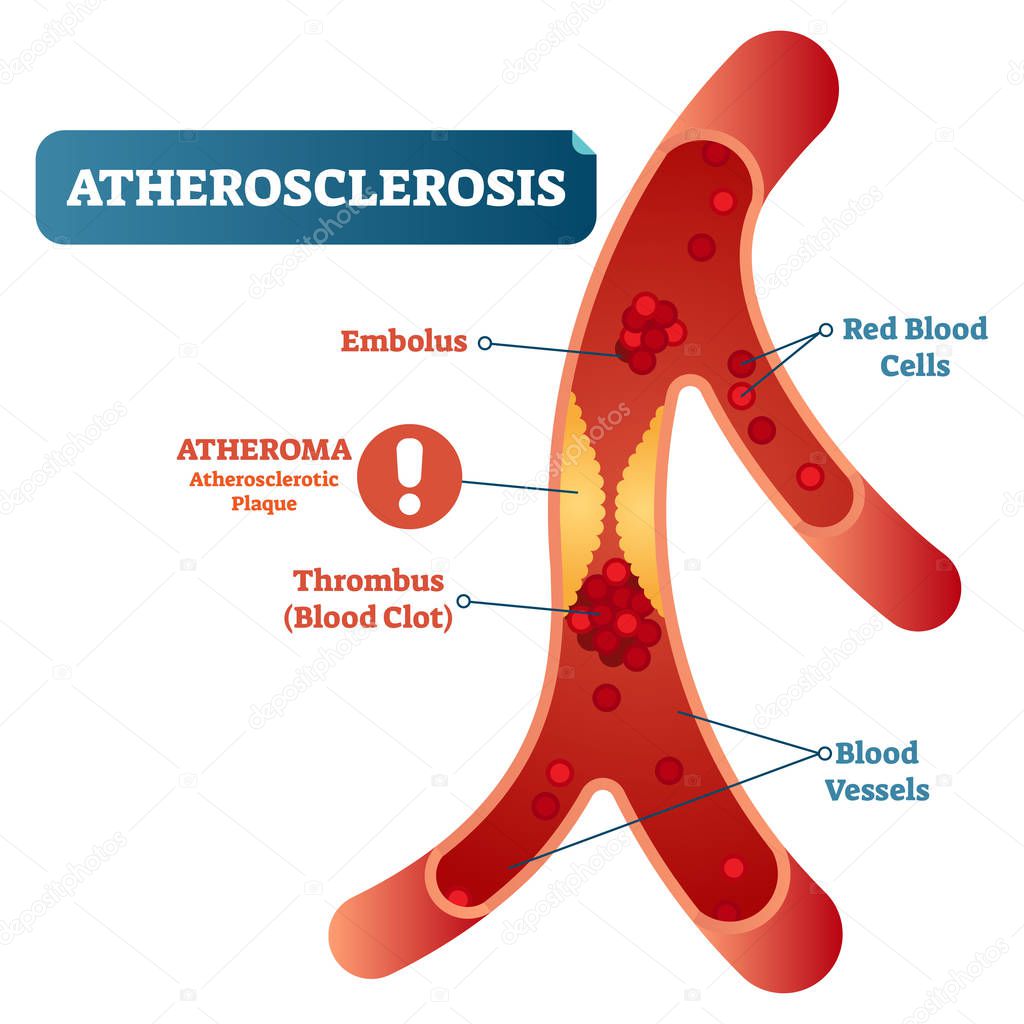 Atherosclerosis medical vector illustration cross section diagram, unhealthy blood vessel circulatory system disease. Blocked blood flow.