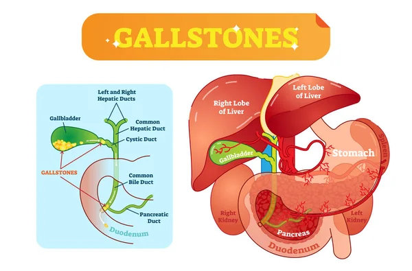 Cálculos biliares sección transversal anatómica diagrama de ilustración vectorial con cavidad abdominal y vesícula biliar, conductos biliares y duodeno . — Archivo Imágenes Vectoriales