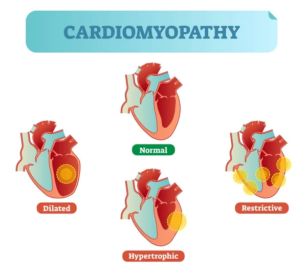 Cardiomyopathie troubles médicaux diagramme en coupe transversale, exemples d'illustration vectorielle avec des conditions normales, dilatées, hypertrophiques et restrictives . — Image vectorielle