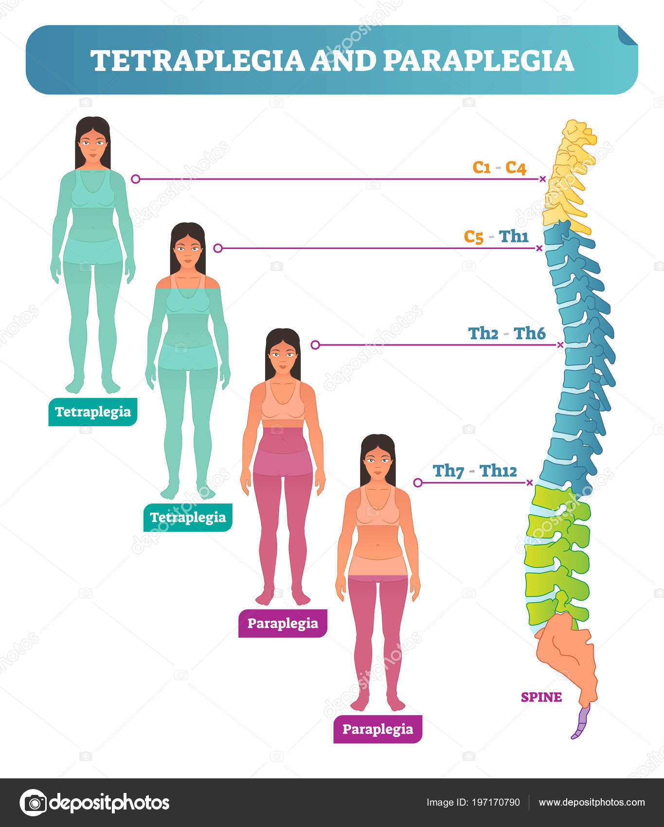 TETRAPLEGIA E PARAPLEGIA EBOOK DOWNLOAD TETRAPLEGIA E PARAPLEGIA EBOOK DOWNLOAD