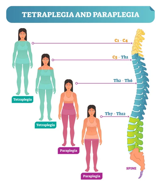 Tetraplejia y paraplejia Trastorno neural espinal Diagrama de ilustración de vectores médicos con paciente femenino y esquema de sección transversal de la columna vertebral . — Archivo Imágenes Vectoriales