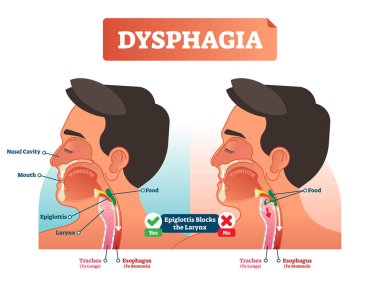 Vector illustration about dysphagia and compered it in scheme. Close-up human with nasal cavity, mouth, tongue, epiglottis, larynx, food, trachea and esophagus. clipart