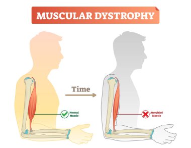 Vector illustration about muscular dystrophy. Compared normal muscle and atrophied muscle. Medical scheme how time affects health - healthy and weak human. clipart