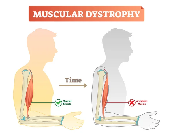Vector illustration about muscular dystrophy. Compared normal muscle and atrophied muscle. Medical scheme how time affects health - healthy and weak human. — Stock Vector
