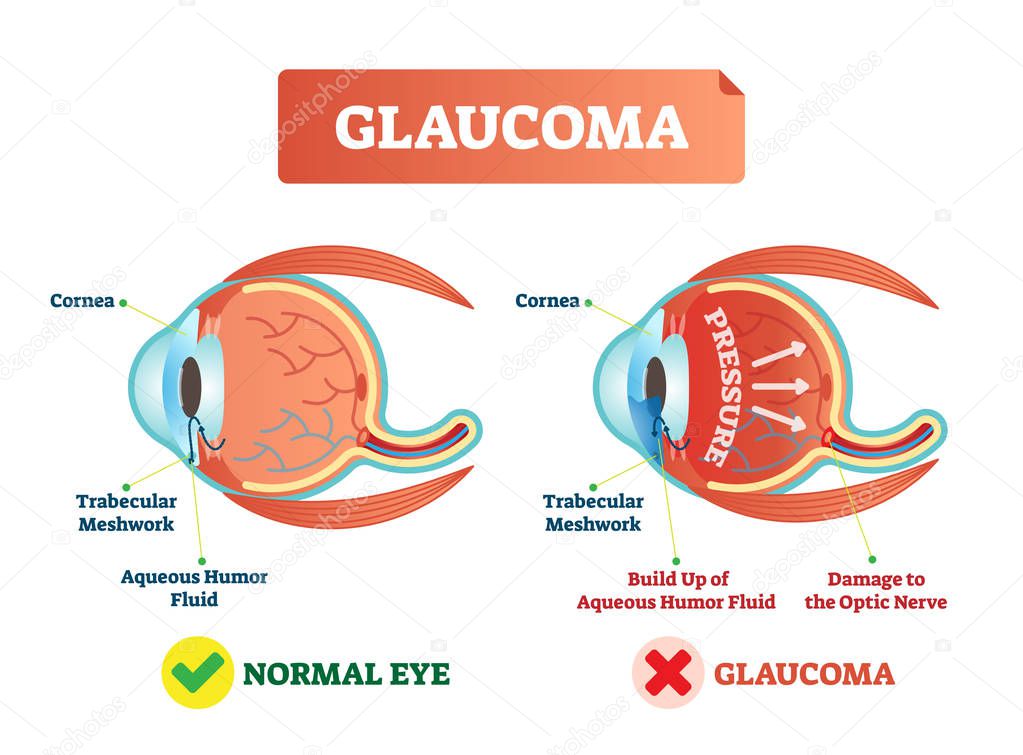 Vector illustration of glaucoma illness. Cross section comparement with normal and damaged eye. Scheme with cornea, trabecular meshwork and aqueous humor fluid.
