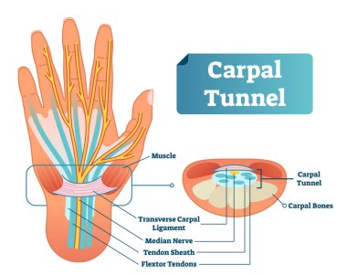 Carpal tunnel vector illustration scheme. Medical labeled diagram closeup with muscle, transverse carpal ligament, median nerve, tendon sheath, flextor tendons and bones. clipart