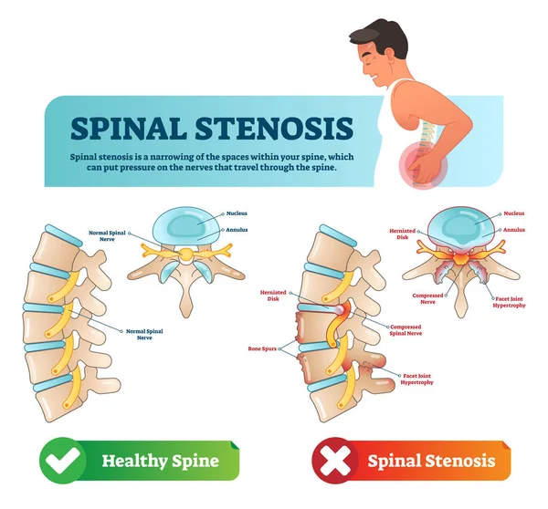 Spinal stenos vektorillustration. Märkt medicinska system med förklaring. Diagram med normala spinal nerv, kärna, annulus, ben sporrar och komprimerade spinal nerv. — Stock vektor